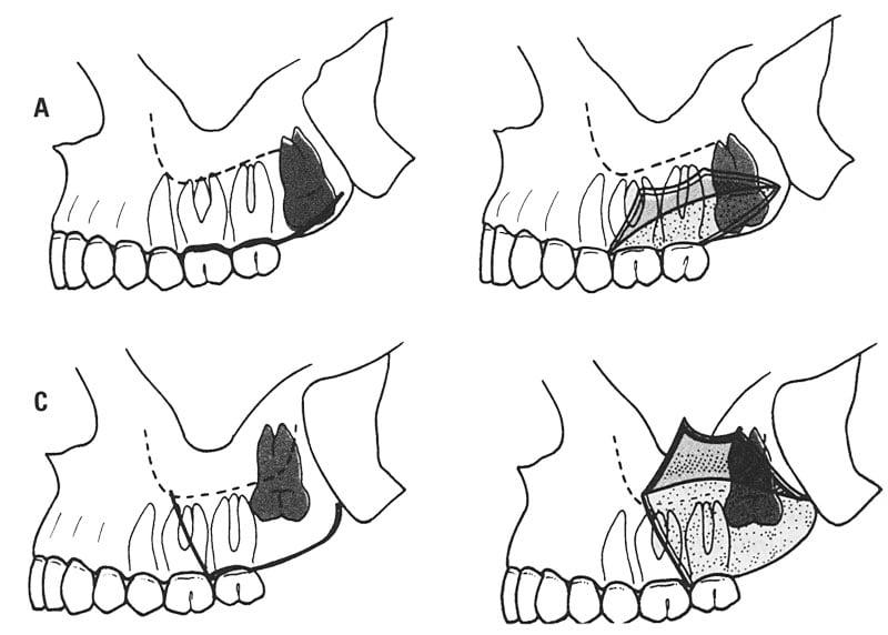 Gojenie po ekstrakcji zęba