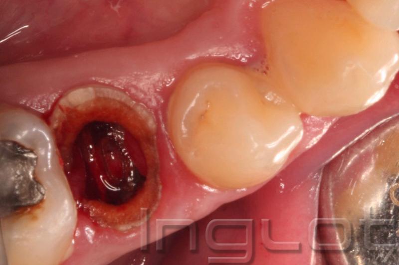 Regeneracja dziąseł