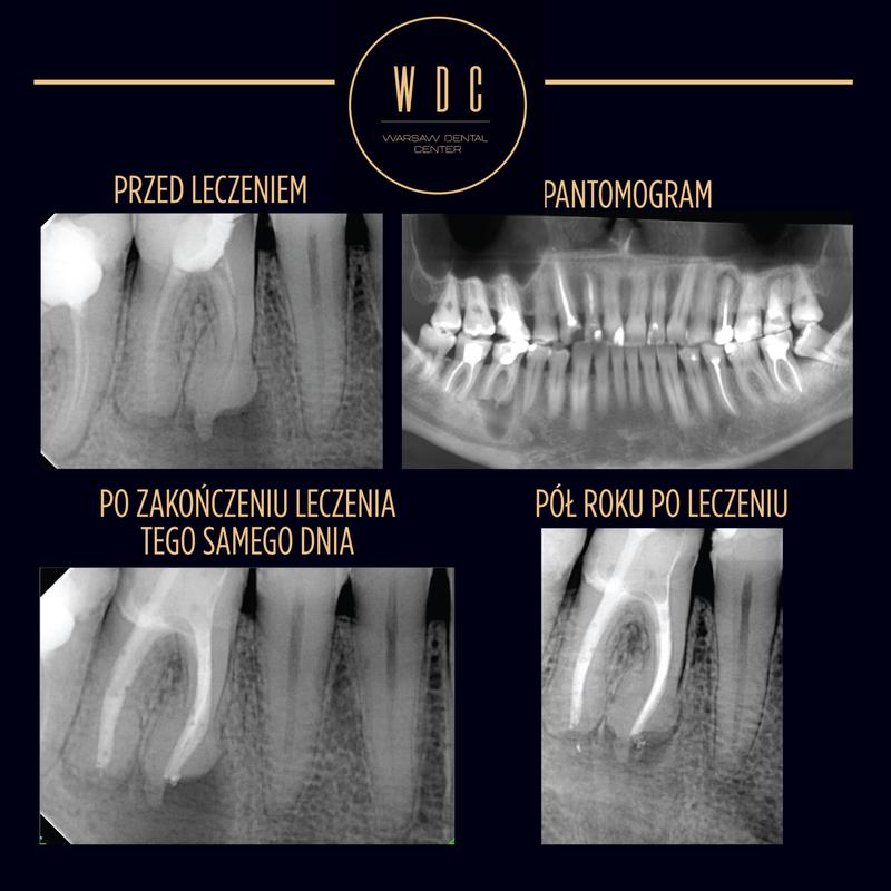 Ile czasu po leczeniu kanałowym lepiej unikać alkoholu?