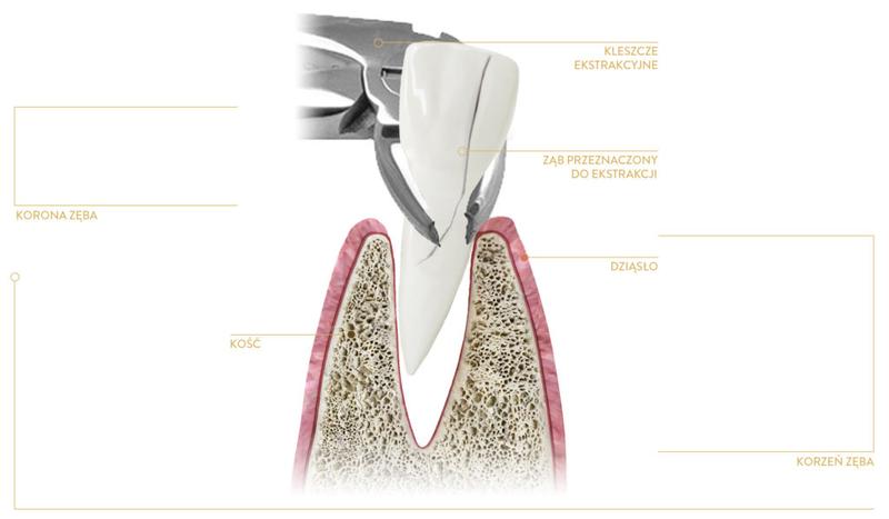 Jak picie alkoholu po ekstrakcji zęba wpływa na proces gojenia?